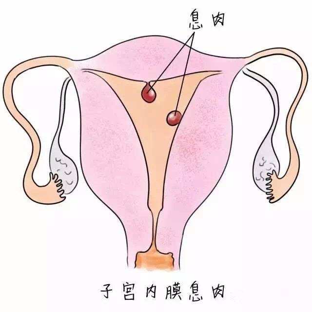 子宫内膜有息肉能怀孕吗