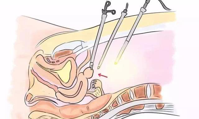 宫腔镜检查是怎样帮助怀孕的？